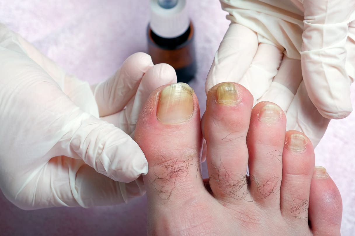 Лечение грибка ногтей: методы, особенности, описание процедуры и последствий